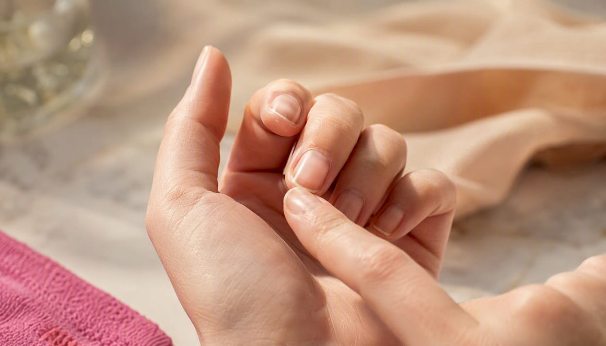 Hand met duidelijk beschadigde nagelriem